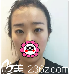 北京清木切開雙眼皮+開眼角案例術前照 北京清木切開雙眼皮+開眼角案例術前照
