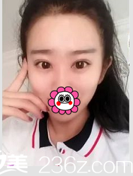 北京清木雙眼皮案例術后35天效果 北京清木雙眼皮案例術后35天效果