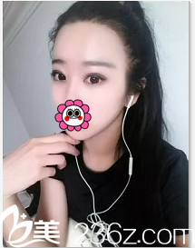 快來看我在北京清木找包靖醫(yī)生做切開雙眼皮+開眼角前后對比效果如何