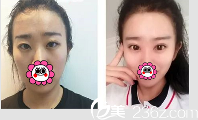 北京清木整形切開雙眼皮開眼角案例對比照 北京清木整形切開雙眼皮開眼角案例對比照