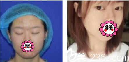 韓國名品整形外科醫(yī)院李燦韓式雙眼皮真人案例術(shù)前照 韓國名品整形外科醫(yī)院李燦韓式雙眼皮真人案例術(shù)前照