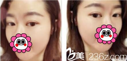 韓國名品整形外科醫(yī)院李燦韓式雙眼皮真人案例術(shù)后第七天 韓國名品整形外科醫(yī)院李燦韓式雙眼皮真人案例術(shù)后第七天