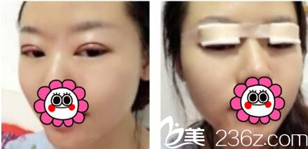 韓國名品整形外科醫(yī)院李燦韓式雙眼皮真人案例術(shù)后第三天 韓國名品整形外科醫(yī)院李燦韓式雙眼皮真人案例術(shù)后第三天