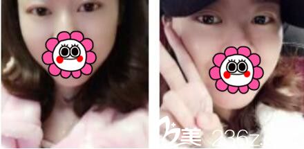 韓國名品整形外科醫(yī)院李燦韓式雙眼皮真人案例術(shù)后十五天 韓國名品整形外科醫(yī)院李燦韓式雙眼皮真人案例術(shù)后十五天