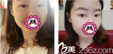 趕時(shí)髦的我去韓國名品找李燦做了韓式雙眼皮，眼睛恢復(fù)的超自然