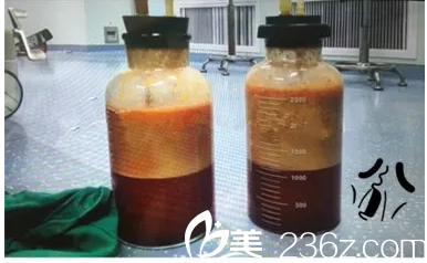 吸脂手術(shù)過程中