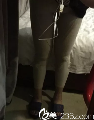 術(shù)后一周大腿吸脂恢復(fù)