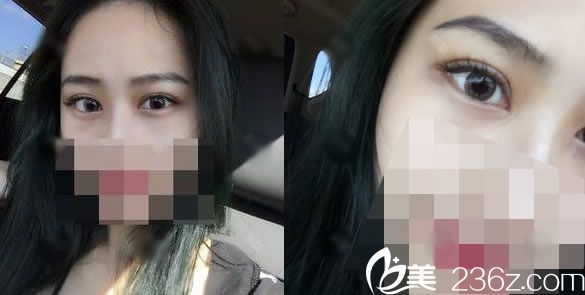 臺(tái)州維多利亞艾長安割雙眼皮怎么樣?安安用雙眼皮術(shù)后30天恢復(fù)效果圖告訴你
