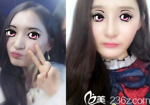 湖州尚麗李翔隆鼻案例效果圖 湖州尚麗李翔隆鼻案例效果圖