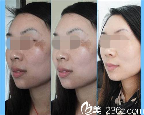 康寶峰醫(yī)生激光祛斑案例 康寶峰醫(yī)生激光祛斑案例