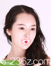 大齡女自述在滄州靜港注射完玻尿酸分分鐘面部飽滿變蘿莉 10天后法令紋和淚溝全消失