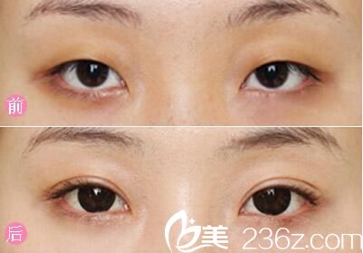 雙眼皮整形前后對(duì)比 雙眼皮整形前后對(duì)比