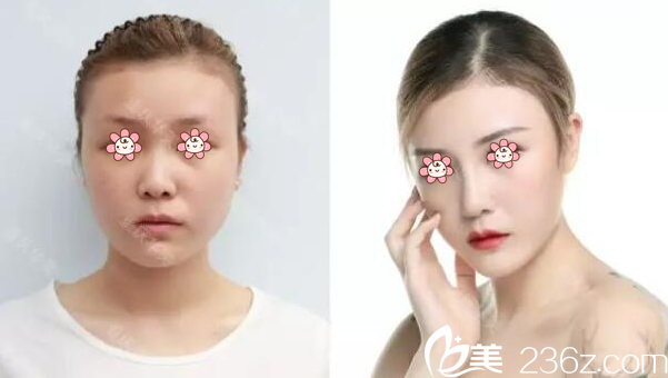 楊健達(dá)拉斯隆鼻案例 楊健達(dá)拉斯隆鼻案例