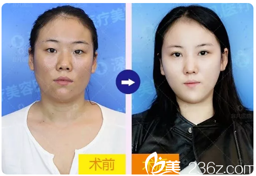 深圳非凡整形醫(yī)院丁峰醫(yī)生雙眼皮案例對(duì)比圖 深圳非凡整形醫(yī)院丁峰醫(yī)生雙眼皮案例對(duì)比圖