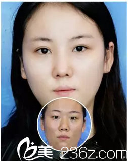 深圳非凡整形醫(yī)院丁峰雙眼皮案例對比圖