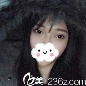 看萬醫(yī)生給我割的雙眼皮，一個(gè)月后自然無痕，超級自然