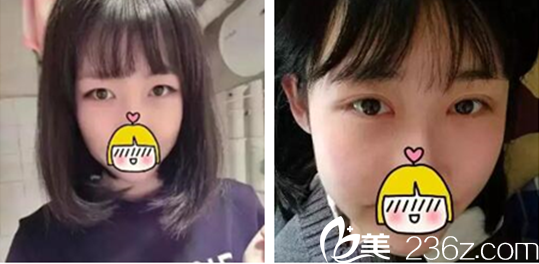 劉圓醫(yī)師美眼案例 劉圓醫(yī)師美眼案例