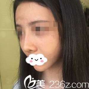 隆鼻失敗的我 隆鼻失敗的我