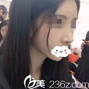 找趙福德院長取鼻假體+膨體隆鼻，分享我鼻綜合修復(fù)一個(gè)月恢復(fù)全過程