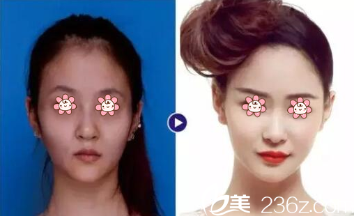 楊加富主任自體脂肪面部填充案例