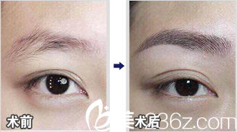 北京米蘭柏羽麗都馬建民眉毛種植效果 北京米蘭柏羽麗都馬建民眉毛種植效果