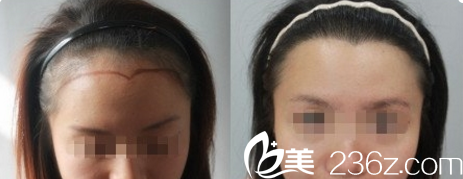 北京米蘭柏羽麗都美人尖種植效果 北京米蘭柏羽麗都美人尖種植效果