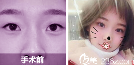 石海山醫(yī)師雙眼皮案例 石海山醫(yī)師雙眼皮案例