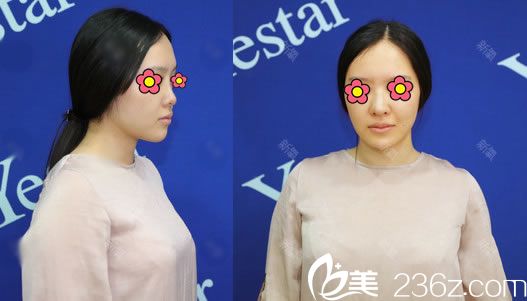 杭州瑞麗醫(yī)療美容醫(yī)院蹇洪術(shù)前照片1