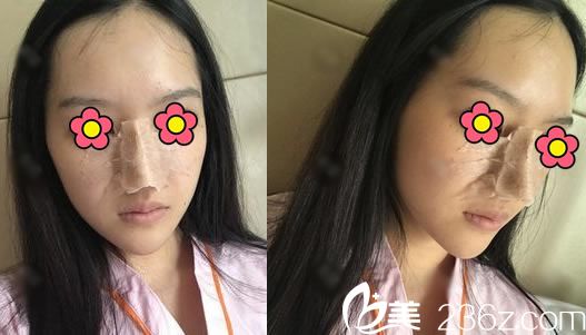 做完肋軟骨隆鼻手術(shù)當(dāng)天照片 做完肋軟骨隆鼻手術(shù)當(dāng)天照片