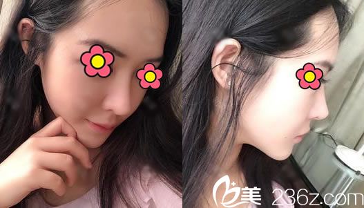 找杭州瑞麗做隆鼻20天后 找杭州瑞麗做隆鼻20天后