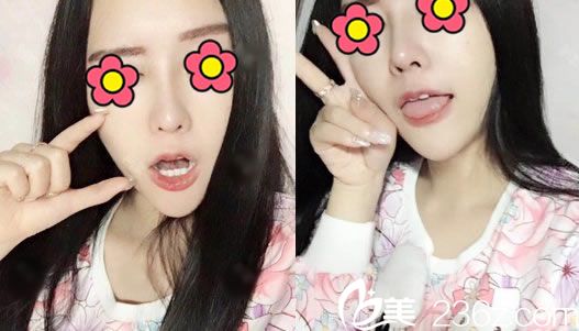 肋軟骨隆鼻手術(shù)60天恢復(fù)<span style= 肋軟骨隆鼻手術(shù)60天恢復(fù)<span style=