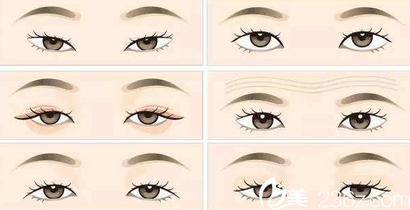 桂林秀美割雙眼皮多少錢？韓式雙眼皮5800元起就能做