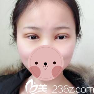 術(shù)后第二天效果 術(shù)后第二天效果