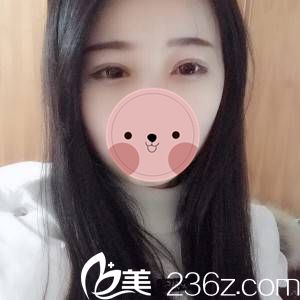 公開我在做的切開雙眼皮術(shù)后半個月恢復全過程日志 包你看了也會心動