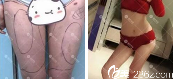 張梅醫(yī)師大腿吸脂案例 張梅醫(yī)師大腿吸脂案例