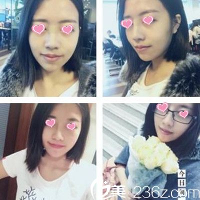 隆鼻術(shù)后12天 隆鼻術(shù)后12天