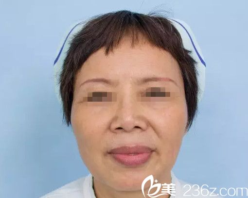 在南寧夢(mèng)想做自體脂肪活細(xì)胞移植前 在南寧夢(mèng)想做自體脂肪活細(xì)胞移植前