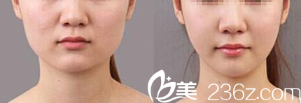 北京米蘭柏羽麗都<!--<i data=20240703-sp></i>-->注射瘦臉案例