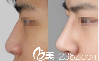 北京米蘭柏羽麗都<!--<i data=20240703-sp></i>-->注射隆鼻案例