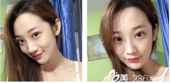 深圳貝漾美天曹思佳雙眼皮術(shù)后六天效果圖 深圳貝漾美天曹思佳雙眼皮術(shù)后六天效果圖