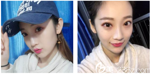 感覺花一萬多元在深圳貝漾美天醫(yī)療美容醫(yī)院找曹思佳做的切開雙眼皮好值哦