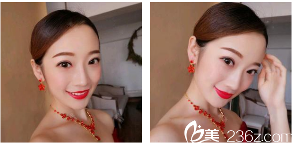 深圳貝漾美天曹思佳雙眼皮案例術(shù)后兩個(gè)月圖片 深圳貝漾美天曹思佳雙眼皮案例術(shù)后兩個(gè)月圖片