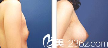 韓國UBA內視鏡隆胸手術真人<span style= 韓國UBA內視鏡隆胸手術真人<span style=