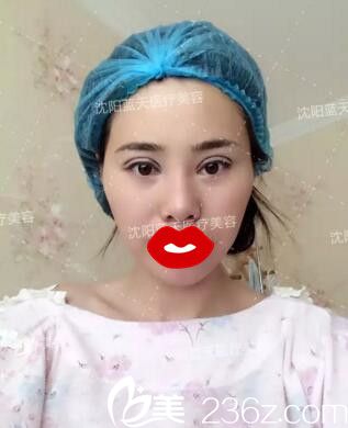 全切雙眼皮手術(shù)當天 全切雙眼皮手術(shù)當天