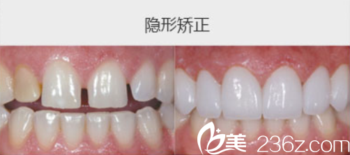 吳承瓊主任隱形矯正案例 吳承瓊主任隱形矯正案例