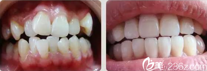 苗智許醫(yī)師口腔正畸案例