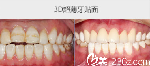 丁愛師牙貼面案例 丁愛師牙貼面案例