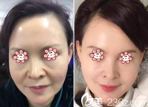 杜航航面部年輕化案例