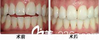 遇海波牙齒矯正案例 遇海波牙齒矯正案例