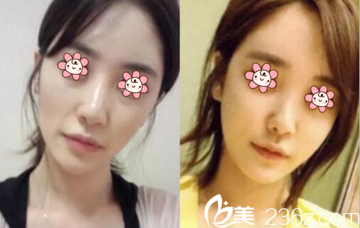 陳先鳳醫(yī)師面部脂肪填充案例